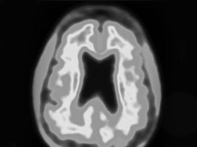 A human brain with dementia